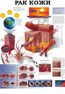 Рак. Рак кожи